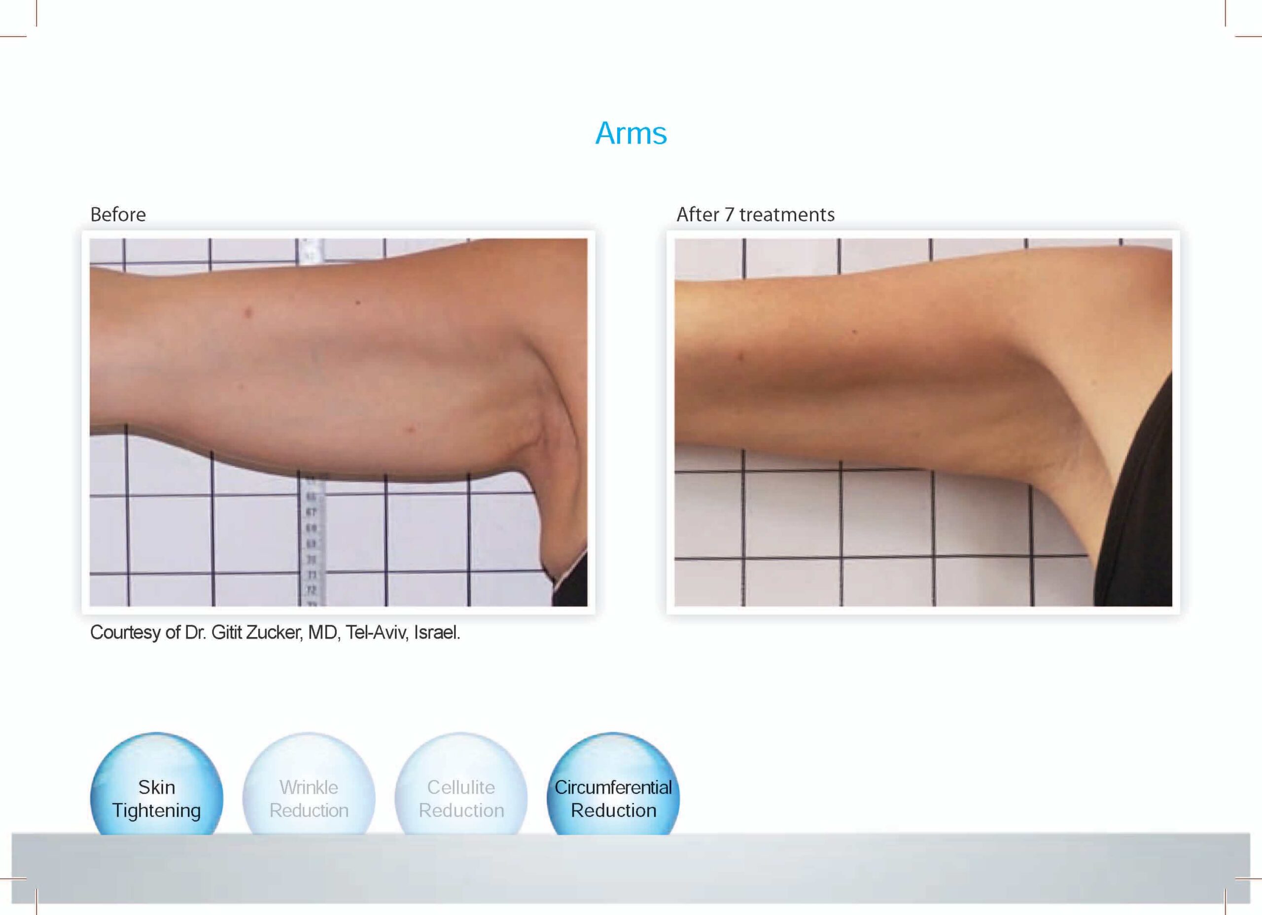 before and after arm skin tightening and circumferencial reduction
