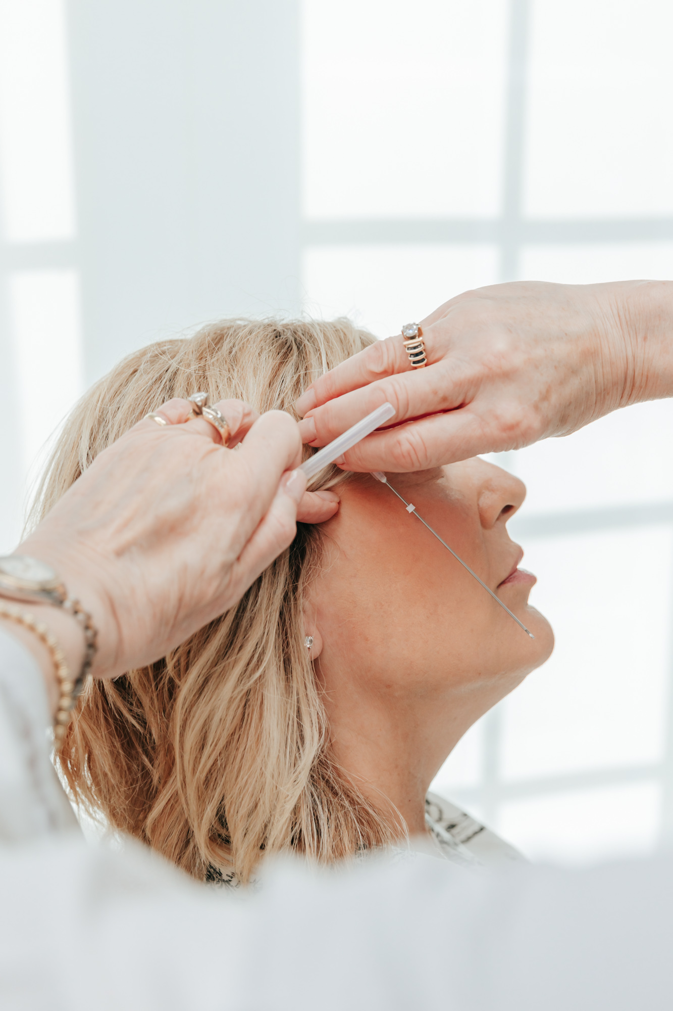 Medium shot of a woman's cheek with a provider's hand using the insertion cannela to measure the distance for a PDO Thread Lift Near Palm Beach