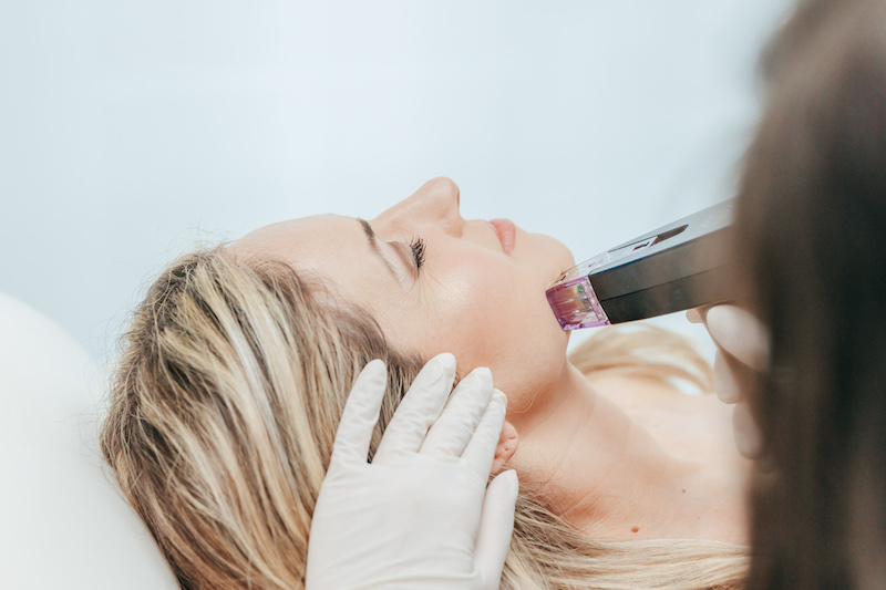 Closeup of a blonde woman's face as she gets Morpheus8 treatment as part of her body sculpting near Palm Beach Gardens