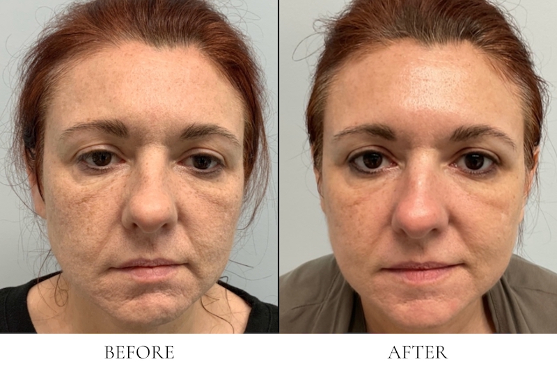 A before and after facial closeup of a women who had Morpheus near Palm Beach