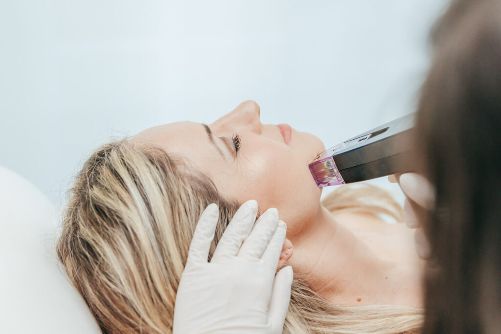 Picture of a lovely woman laying on a treatment bed with a handpiece on her chin receiving Morpheus8 as your summer-safe solution for Sunspots