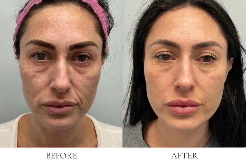 Closeup of a woman's face with dark hair and eyebrows before and after having Morpheus8 in West Palm Beach